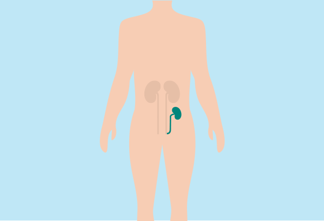 Image of a body with an animation of kidneys showing, with the transplanted kidney